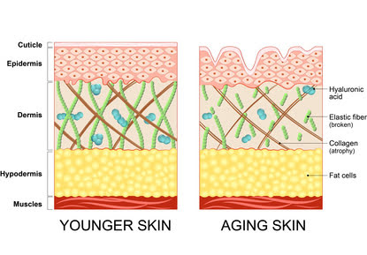 Skin aging due to the lack of collagen